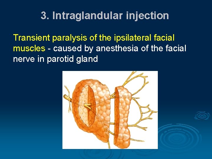 3. Intraglandular injection Transient paralysis of the ipsilateral facial muscles - caused by anesthesia