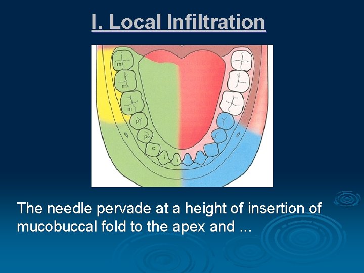 I. Local Infiltration The needle pervade at a height of insertion of mucobuccal fold