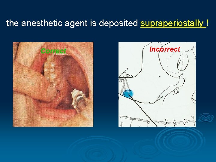 the anesthetic agent is deposited supraperiostally ! Correct Incorrect 