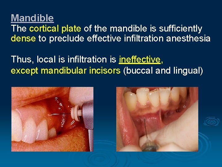 Mandible The cortical plate of the mandible is sufficiently dense to preclude effective infiltration