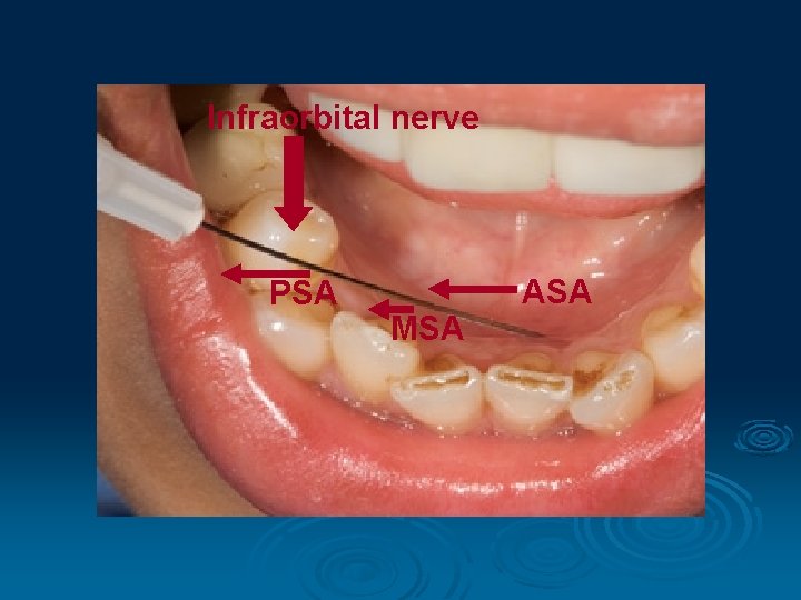Infraorbital nerve PSA MSA ASA 
