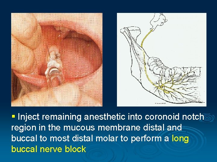 § Inject remaining anesthetic into coronoid notch region in the mucous membrane distal and
