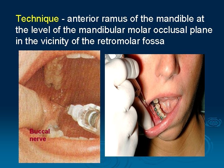 Technique - anterior ramus of the mandible at the level of the mandibular molar