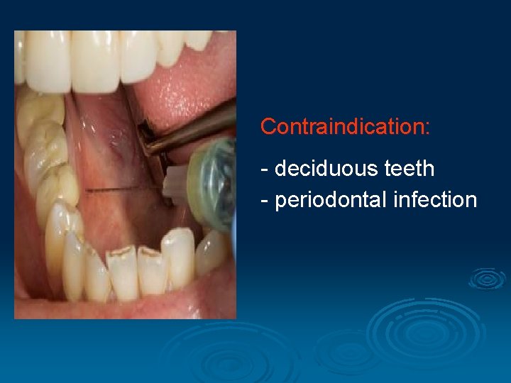 Contraindication: - deciduous teeth - periodontal infection 