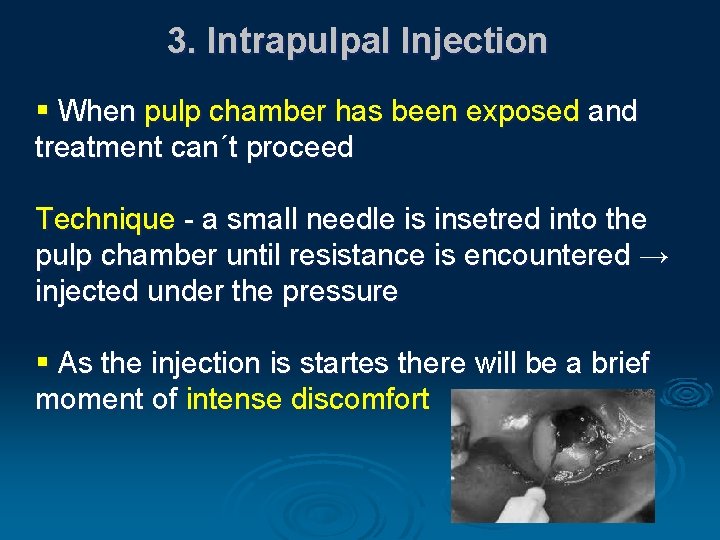 3. Intrapulpal Injection § When pulp chamber has been exposed and treatment can´t proceed