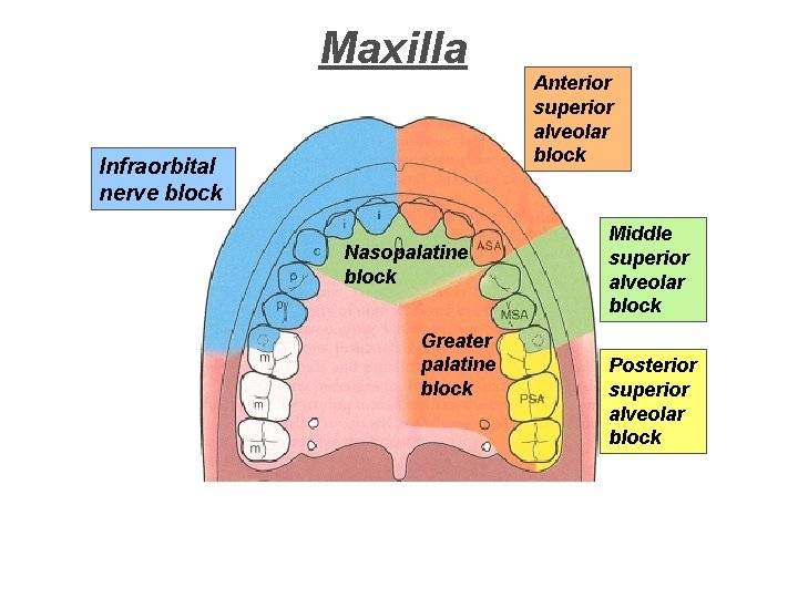 Maxilla Infraorbital nerve block Nasopalatine block Greater palatine block Anterior superior alveolar block Middle