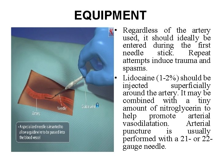 EQUIPMENT • Regardless of the artery used, it should ideally be entered during the EQUIPMENT • Regardless of the artery used, it should ideally be entered during the