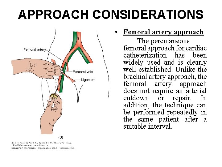APPROACH CONSIDERATIONS • Femoral artery approach The percutaneous femoral approach for cardiac catheterization has APPROACH CONSIDERATIONS • Femoral artery approach The percutaneous femoral approach for cardiac catheterization has