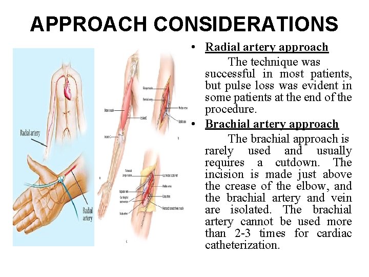 APPROACH CONSIDERATIONS • Radial artery approach The technique was successful in most patients, but APPROACH CONSIDERATIONS • Radial artery approach The technique was successful in most patients, but