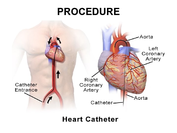 PROCEDURE PROCEDURE