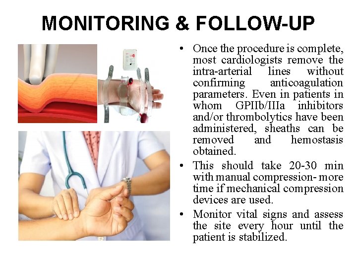 MONITORING & FOLLOW-UP • Once the procedure is complete, most cardiologists remove the intra-arterial MONITORING & FOLLOW-UP • Once the procedure is complete, most cardiologists remove the intra-arterial