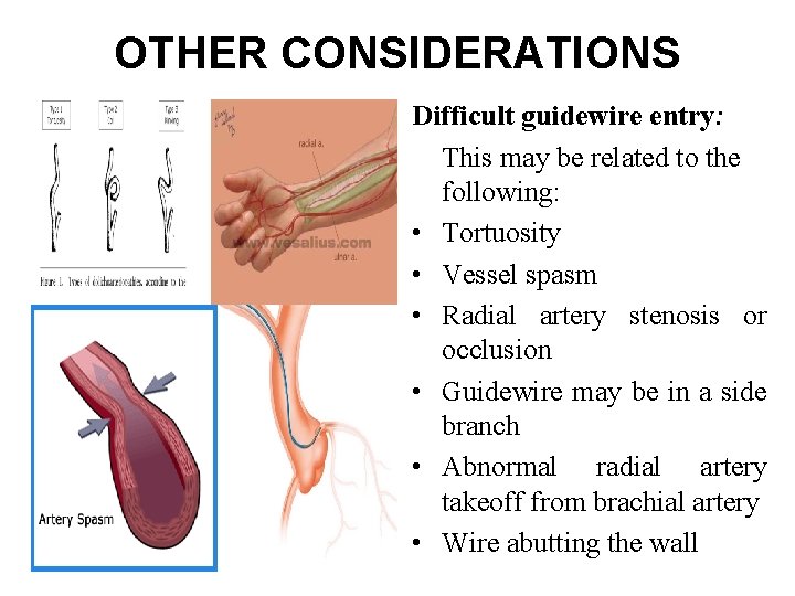 OTHER CONSIDERATIONS Difficult guidewire entry: This may be related to the following: • Tortuosity OTHER CONSIDERATIONS Difficult guidewire entry: This may be related to the following: • Tortuosity