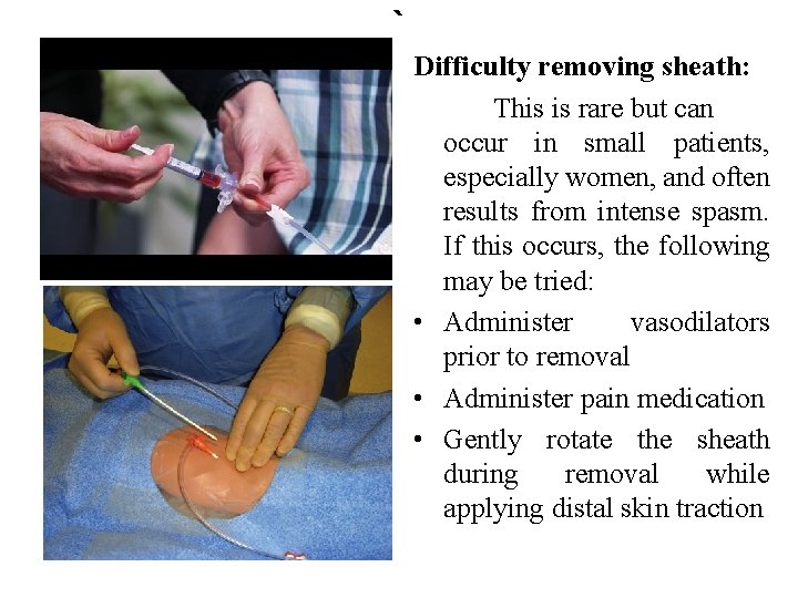 ` Difficulty removing sheath: This is rare but can occur in small patients, especially ` Difficulty removing sheath: This is rare but can occur in small patients, especially