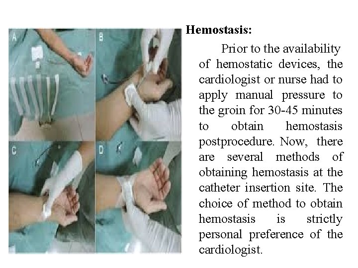 Hemostasis: Prior to the availability of hemostatic devices, the cardiologist or nurse had to Hemostasis: Prior to the availability of hemostatic devices, the cardiologist or nurse had to