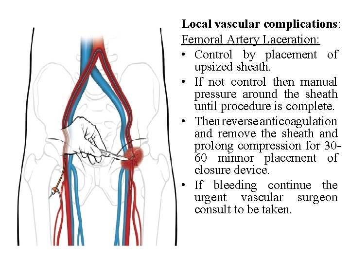 Local vascular complications: Femoral Artery Laceration: • Control by placement of upsized sheath. • Local vascular complications: Femoral Artery Laceration: • Control by placement of upsized sheath. •
