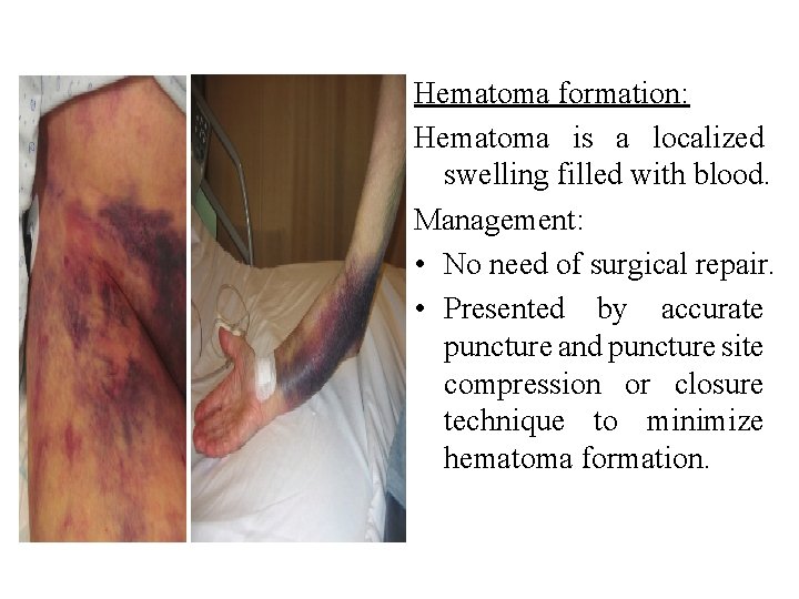 Hematoma formation: Hematoma is a localized swelling filled with blood. Management: • No need Hematoma formation: Hematoma is a localized swelling filled with blood. Management: • No need