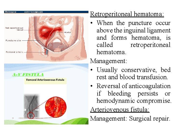 Retroperitoneal hematoma: • When the puncture occur above the inguinal ligament and forms hematoma, Retroperitoneal hematoma: • When the puncture occur above the inguinal ligament and forms hematoma,
