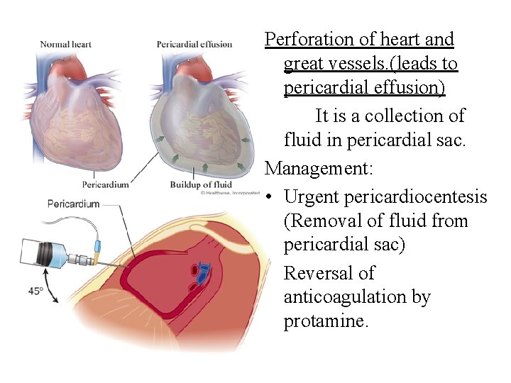 Perforation of heart and great vessels. (leads to pericardial effusion) It is a collection Perforation of heart and great vessels. (leads to pericardial effusion) It is a collection
