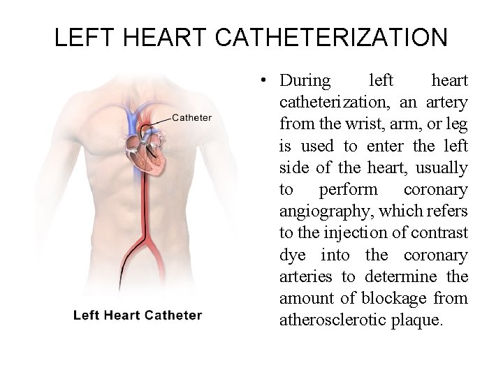 LEFT HEART CATHETERIZATION • During left heart catheterization, an artery from the wrist, arm, LEFT HEART CATHETERIZATION • During left heart catheterization, an artery from the wrist, arm,