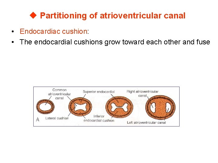 u Partitioning of atrioventricular canal • Endocardiac cushion: • The endocardial cushions grow toward