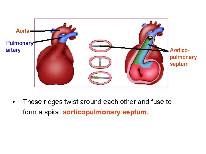 Aorta Pulmonary artery • Aorticopulmonary septum These ridges twist around each other and fuse