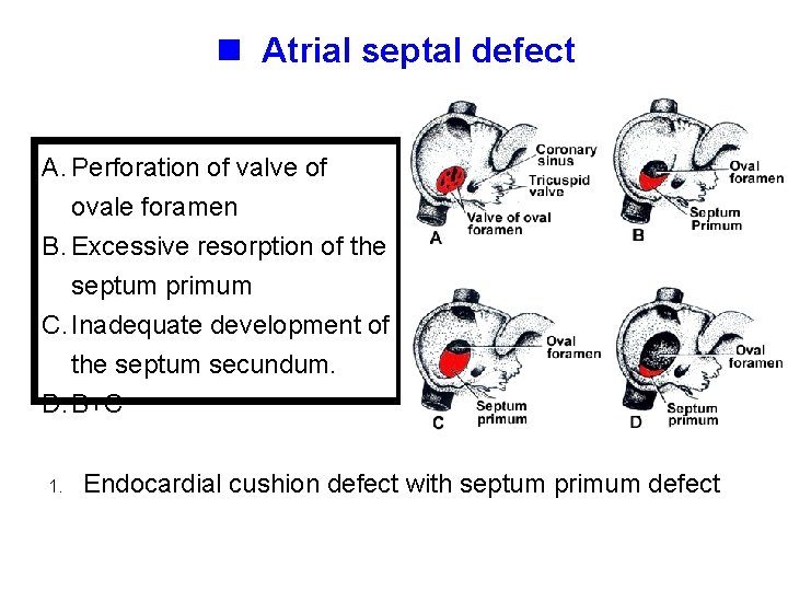 n Atrial septal defect A. Perforation of valve of ovale foramen B. Excessive resorption