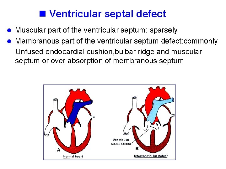 n Ventricular septal defect Muscular part of the ventricular septum: sparsely l Membranous part