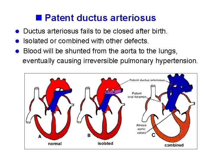 n Patent ductus arteriosus l Ductus arteriosus fails to be closed after birth. l