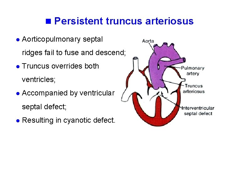 n Persistent truncus arteriosus l Aorticopulmonary septal ridges fail to fuse and descend; l