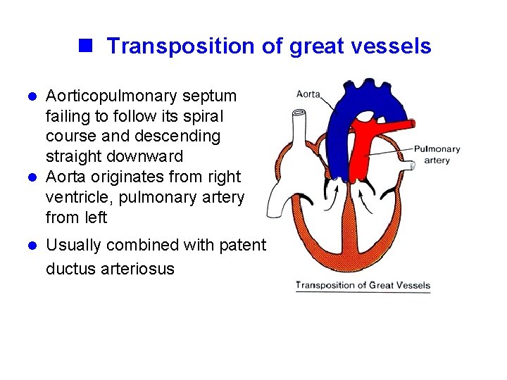 n Transposition of great vessels Aorticopulmonary septum failing to follow its spiral course and