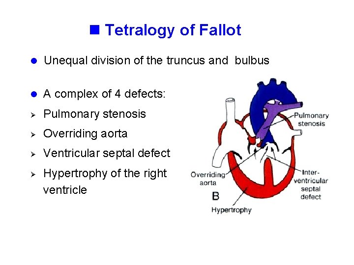 n Tetralogy of Fallot l Unequal division of the truncus and bulbus l A