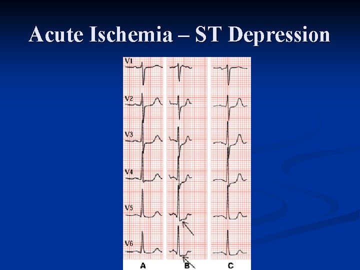 Acute Ischemia – ST Depression 