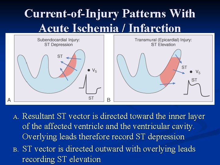 Current-of-Injury Patterns With Acute Ischemia / Infarction A. B. Resultant ST vector is directed