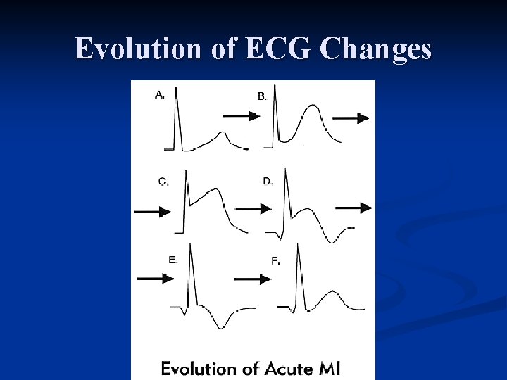 Evolution of ECG Changes 