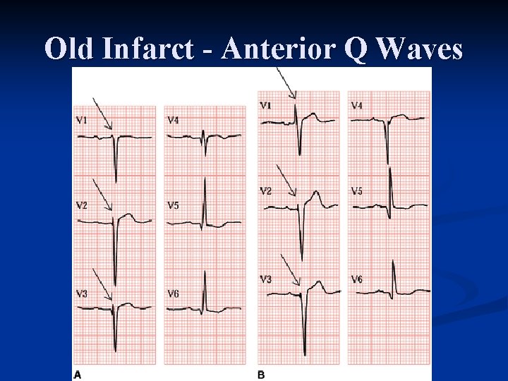 Old Infarct - Anterior Q Waves 