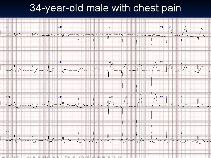 34 -year-old male with chest pain 