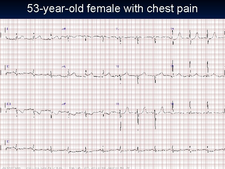 53 -year-old female with chest pain 