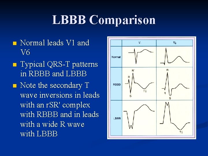 LBBB Comparison n Normal leads V 1 and V 6 Typical QRS-T patterns in