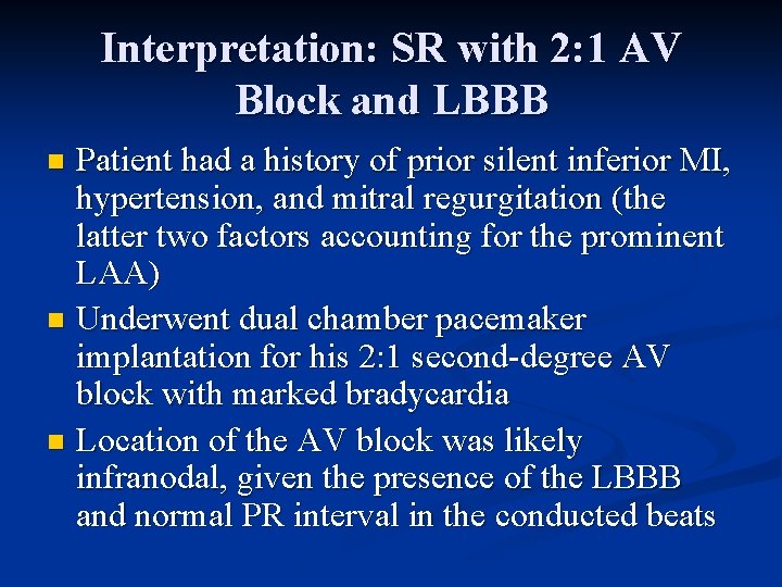 Interpretation: SR with 2: 1 AV Block and LBBB Patient had a history of