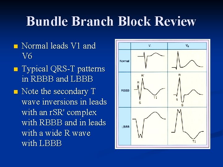 Bundle Branch Block Review n n n Normal leads V 1 and V 6