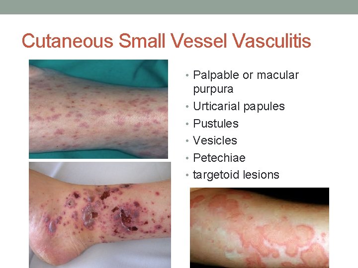 Cutaneous Small Vessel Vasculitis • Palpable or macular purpura • Urticarial papules • Pustules
