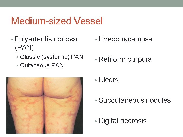 Medium-sized Vessel • Polyarteritis nodosa • Livedo racemosa (PAN) • Classic (systemic) PAN •