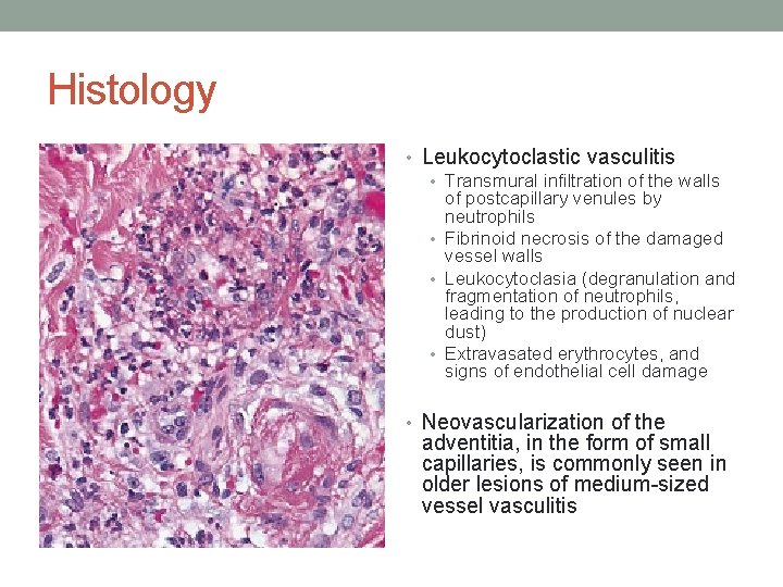 Histology • Leukocytoclastic vasculitis • Transmural infiltration of the walls of postcapillary venules by