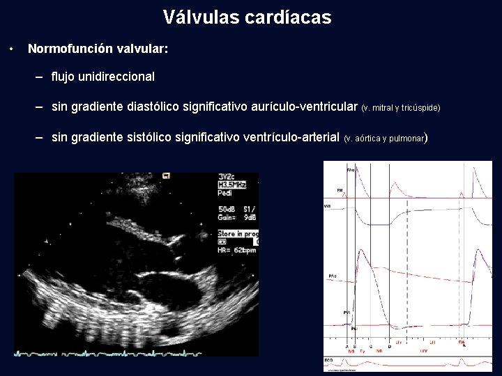 Válvulas cardíacas • Normofunción valvular: – flujo unidireccional – sin gradiente diastólico significativo aurículo-ventricular