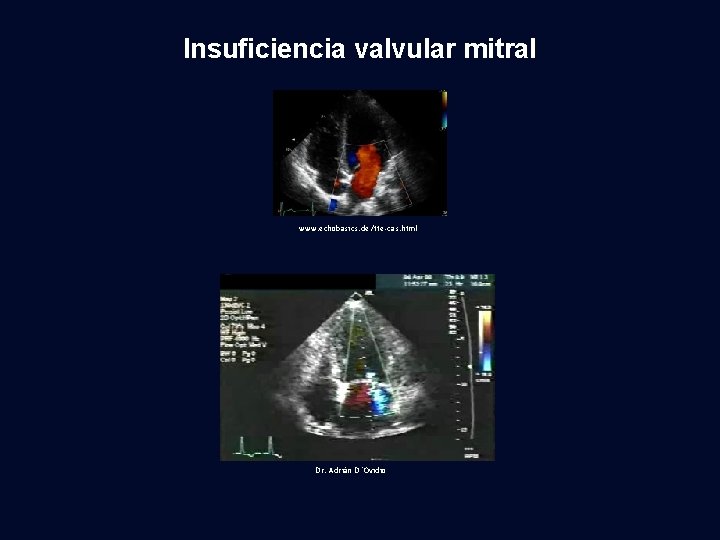 Insuficiencia valvular mitral www. echobasics. de/tte-cas. html Dr. Adrián D´Ovidio 