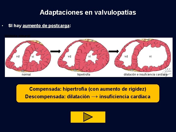 Adaptaciones en valvulopatías • SI hay aumento de postcarga: Historia natural: vd vi normal