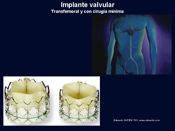 Implante valvular Transfemoral y con cirugía mínima Edwards SAPIEN THV www. edwards. com 