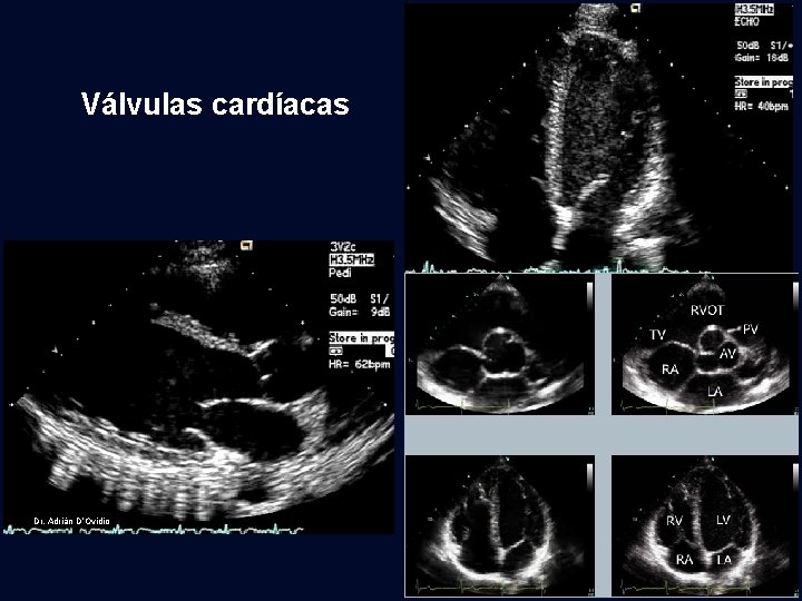 Válvulas cardíacas Dr. Adrián D’Ovidio 