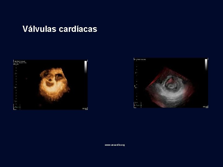 Válvulas cardíacas www. escardio. org 