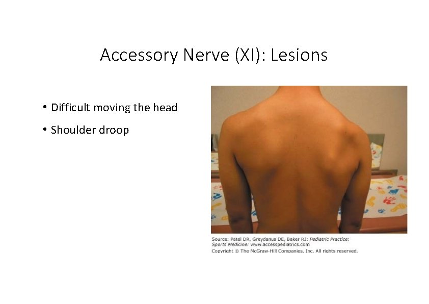 Accessory Nerve (XI): Lesions • Difficult moving the head • Shoulder droop Accessory Nerve (XI): Lesions • Difficult moving the head • Shoulder droop